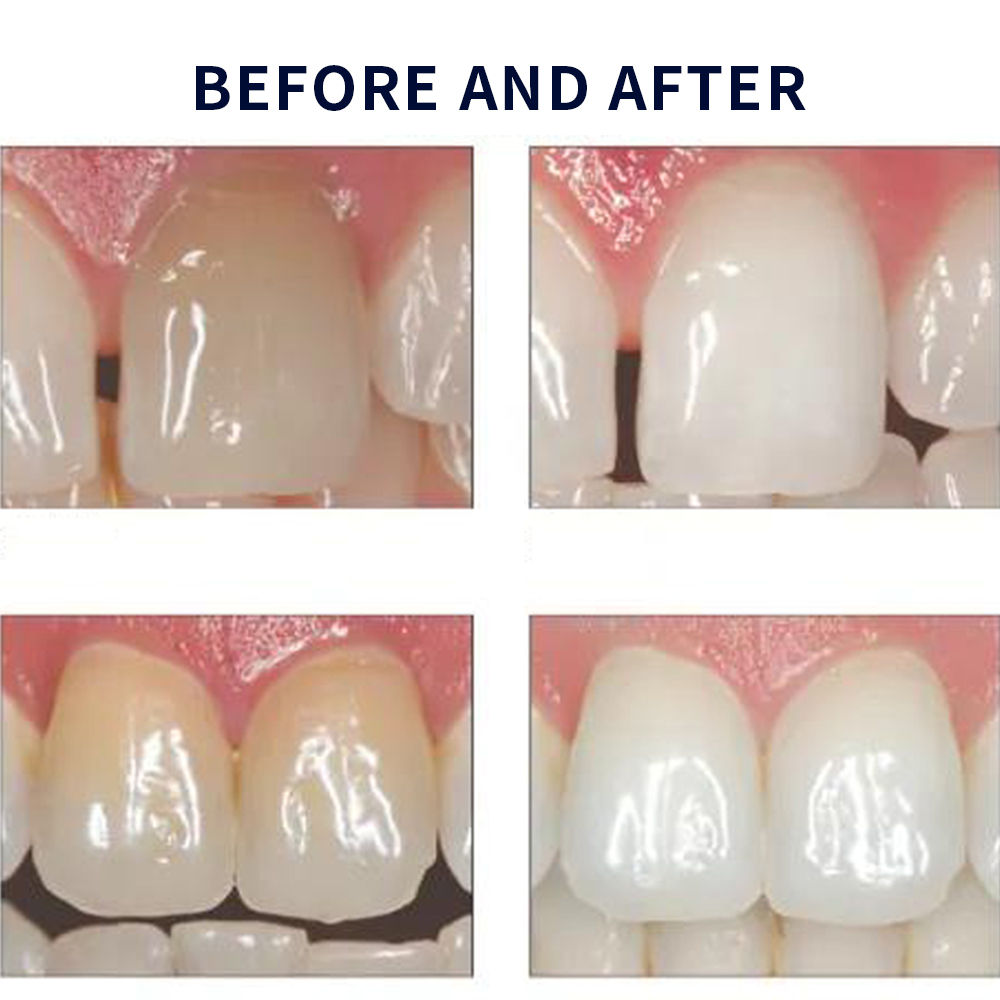 Opale scence White ning 1,2 pf – Teeth Whitening In Office Bewertung und Preis