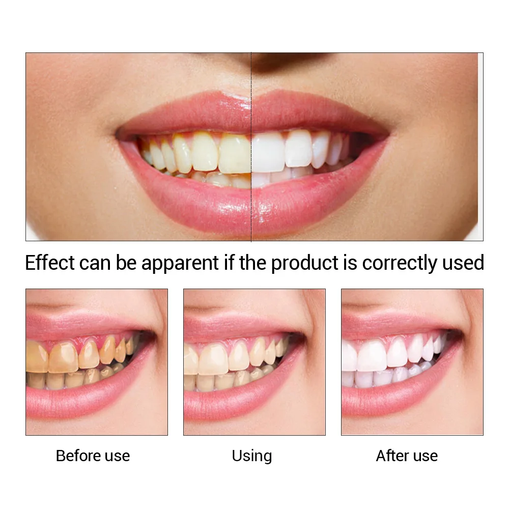 FTEENPLY Zahnaufhellung Essenz – Teeth Whitening Serum Bewertung und Preis
