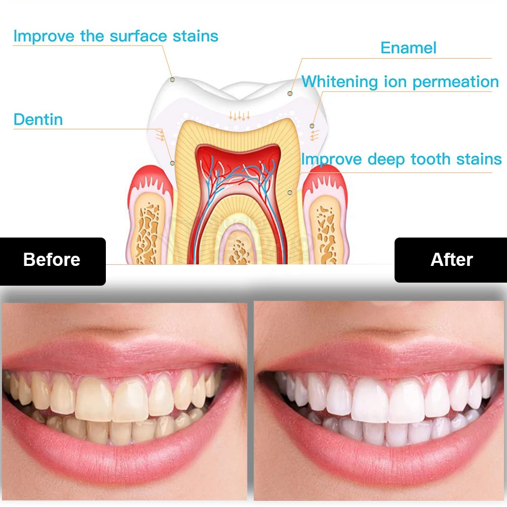 Dental Zahnaufhellung Kit Mini – Teeth Whitening For Trays Bewertung und Preis